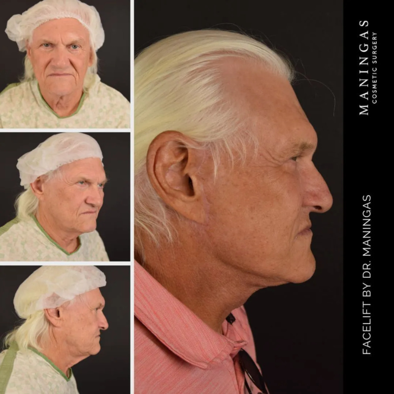 Male patient shown before and after a face and neck lift with Dr. Maningas