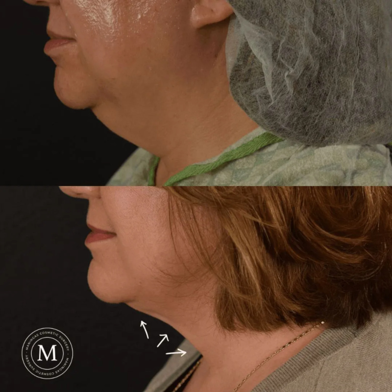 Real patient of Dr. Talon Maningas shown before and then 6 months after her FaceTite procedure