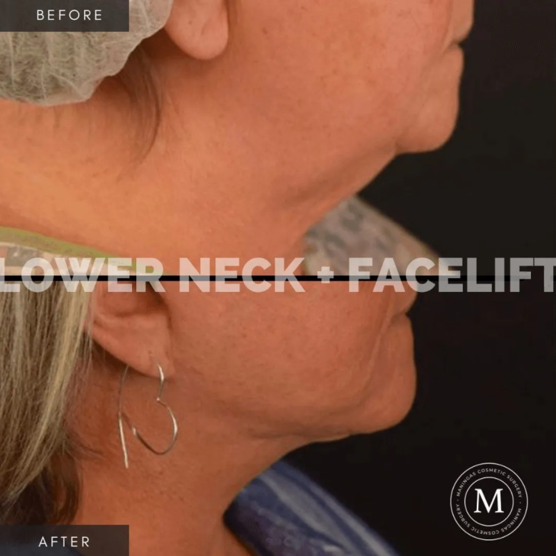 Female patient shown before and after a lower neck and facelift with Dr. talon Maningas