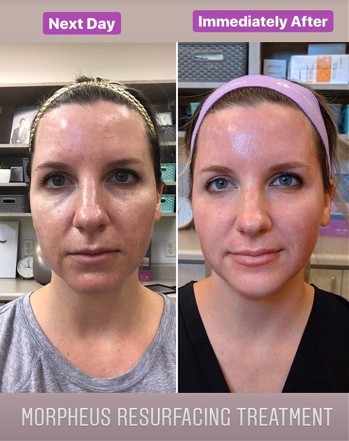 SAme day vs 1 day after Morpheus8 treatment