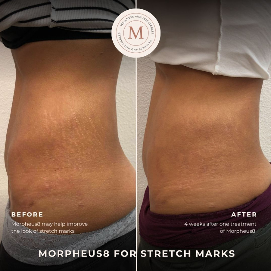 Before and after Morpheus8 for stretch mark reduction