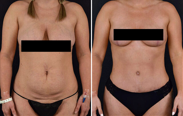 Before and after mommy makeover with tummy tuck and breast reduction with Joplin cosmetic surgeon Dr. Talon Maningas