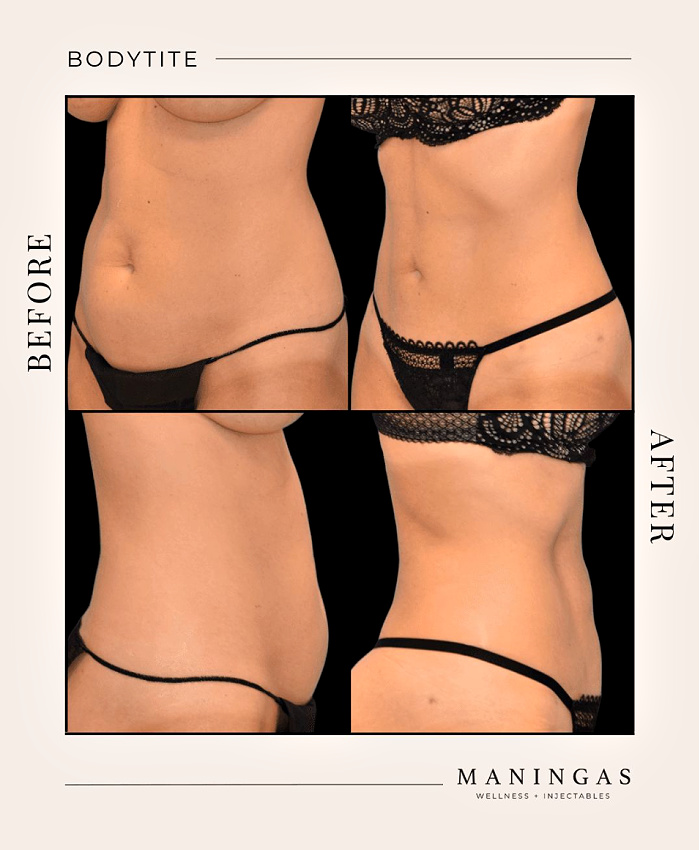 Before and after BodyTite at Joplin med spa and Maningas Cosmetic Surgery center