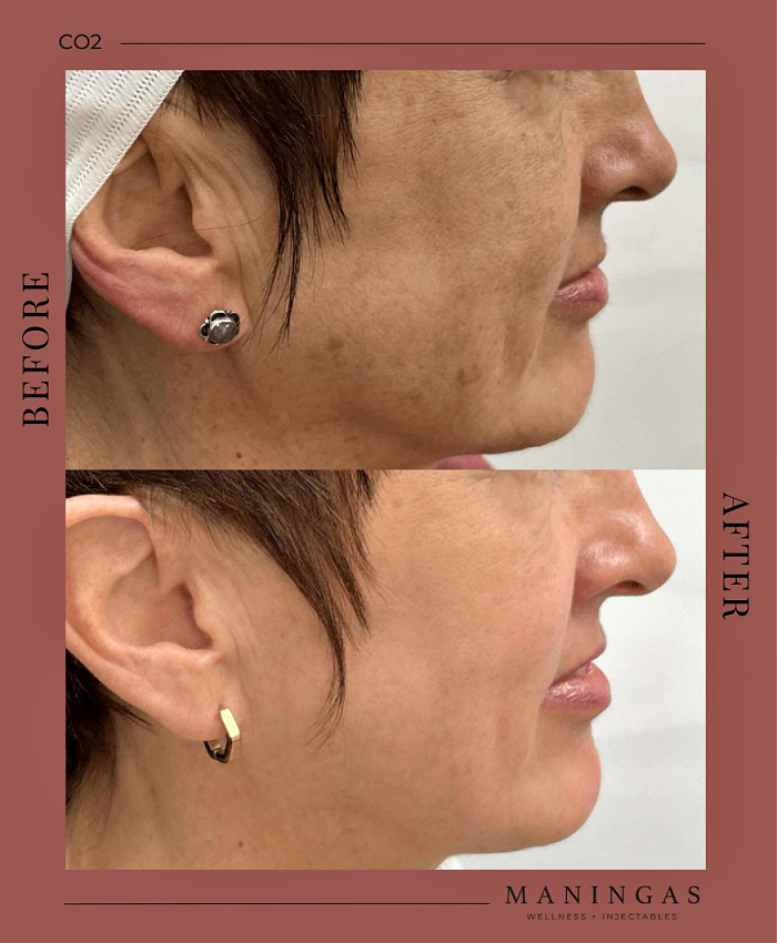 Before and after CO2 laser treatment