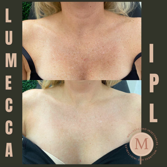 Before and after Lumeccca IPL treatment for sun damage on chest