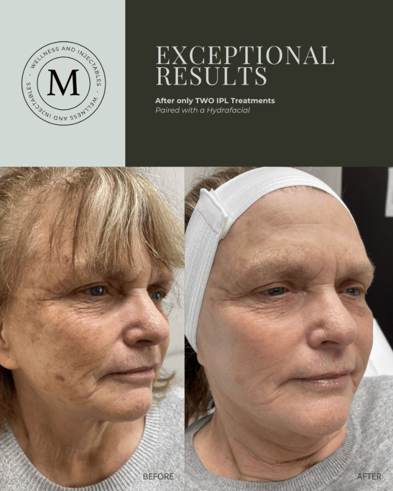 Before and after 2 IPL treatments and a Hydrafacial at Maningas Cosmetic Surgery in Joplin