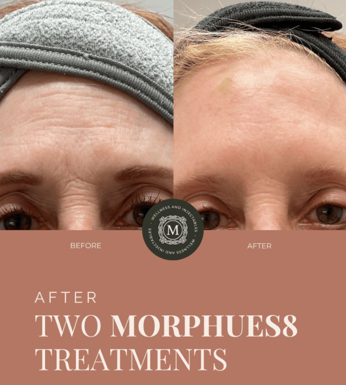 Before and after 2 Morpheus8 treatments for fine lines and wrinkles