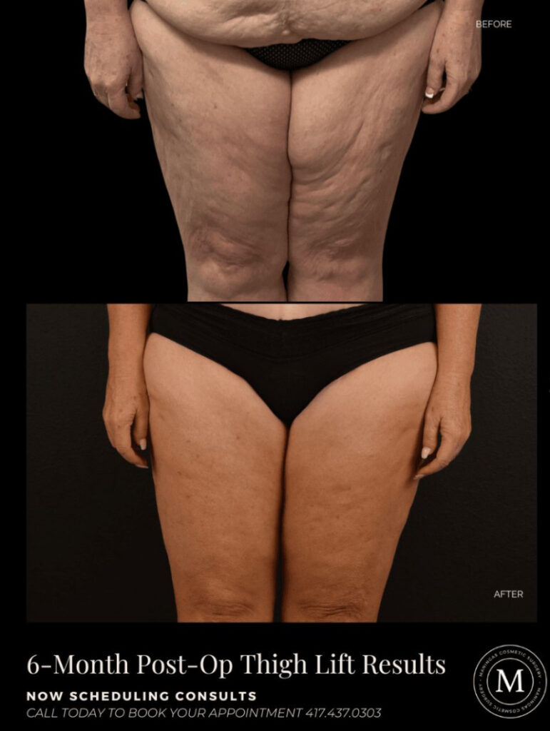 Before and after thigh lift with Dr. Maningas in Joplin