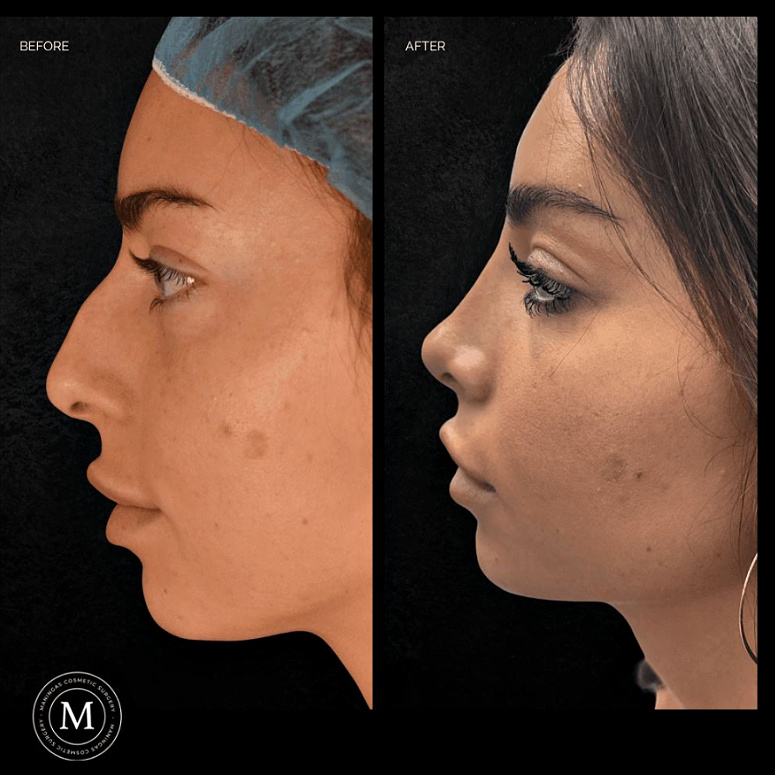 Female patient before and after rhinoplasty with Dr. Maningas in Joplin