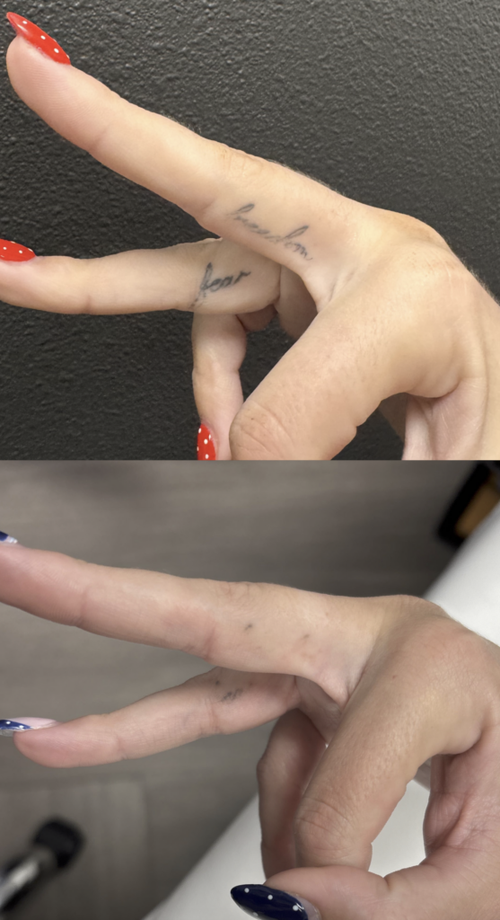 Laser tattoo removal in Joplin